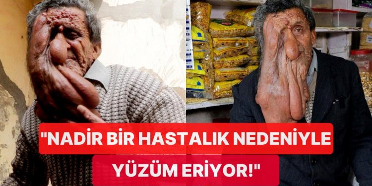 Nadir Bir Hastalık Nedeniyle Yüzü Eriyen Adamın Akıllara Durgunluk Veren Hikayesi